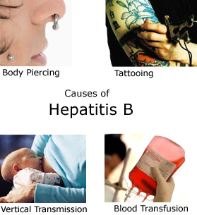 årsager bag hepatitis b